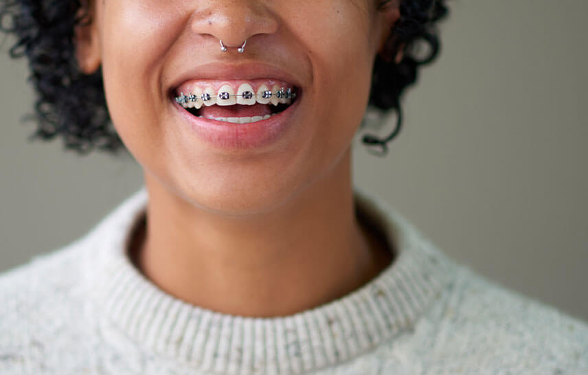 Clear vs metal braces: which is best for you?