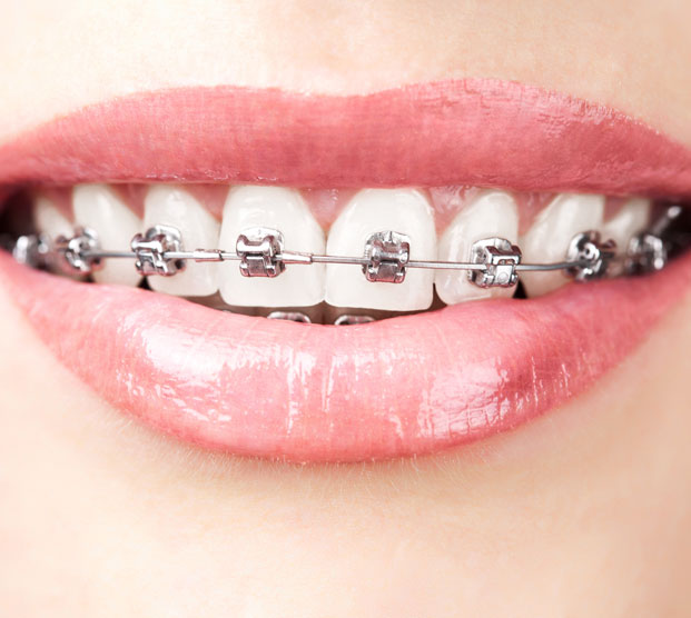 Metal braces