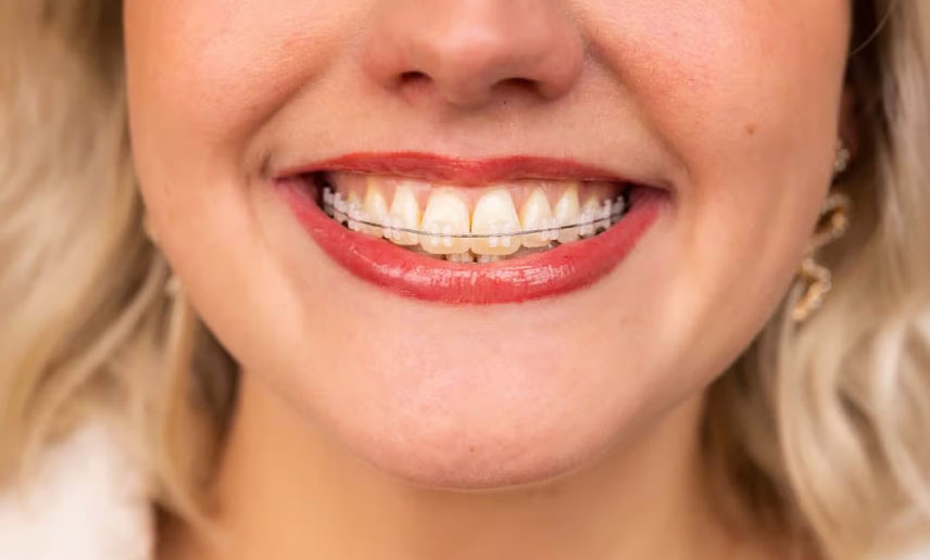 LightForce™ Braces vs Regular Braces: What's The Difference? LightForce™ Braces vs Regular Braces: What's The Difference?