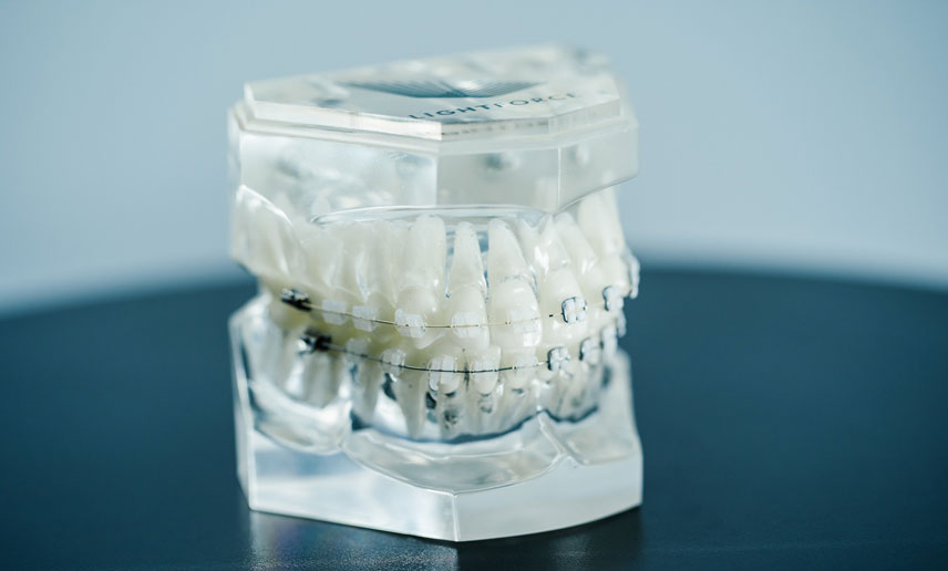 Can Braces Fix an Overbite? Your Guide to Treatment and Results
